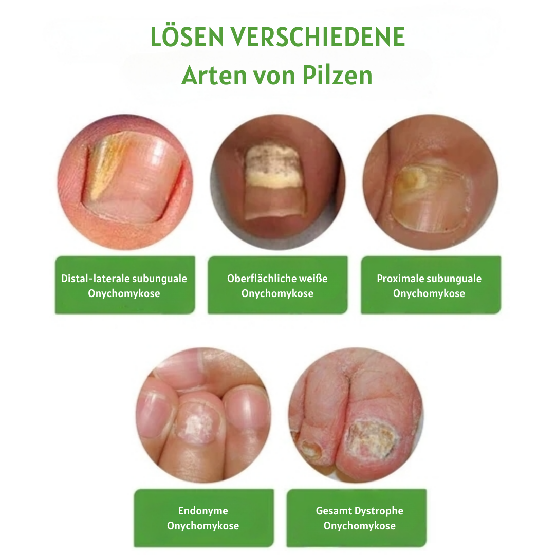 NailFix™ Nagelwachstum und Reparatur Roller (1+1 GRATIS)