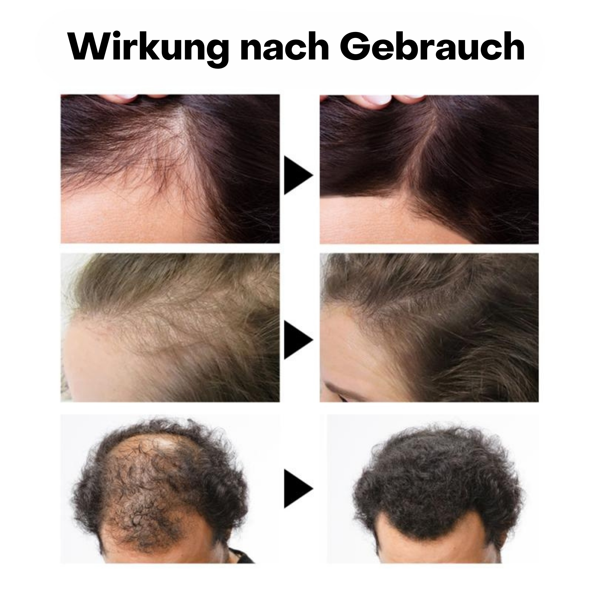 RevitaHair™️ I Haarwachstums-Peeling (1+1 GRATIS)