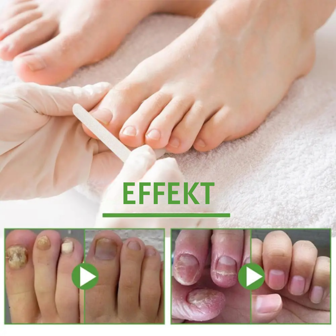 NailFix™ Nagelwachstum und Reparatur Roller (1+1 GRATIS)