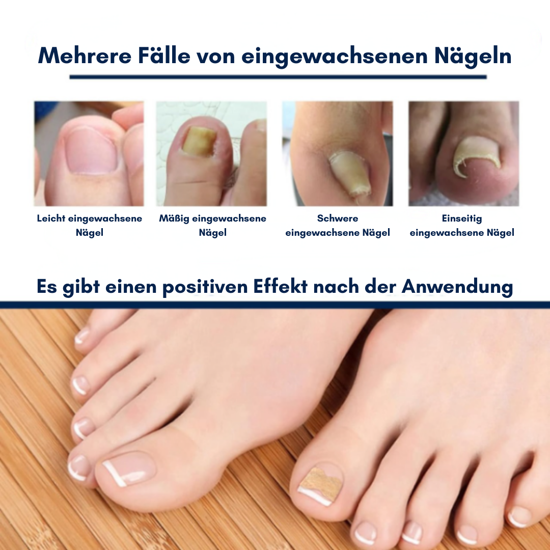 PediPatch™ Zehennagel-Korrekturpflaster (50+50 GRATIS)