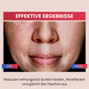 SpotlessGlow™ Dunkler Fleck Korrektor Creme