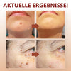 MoleFix™ Hautanhängsel & Maulwurfsentferner (1+1 GRATIS)