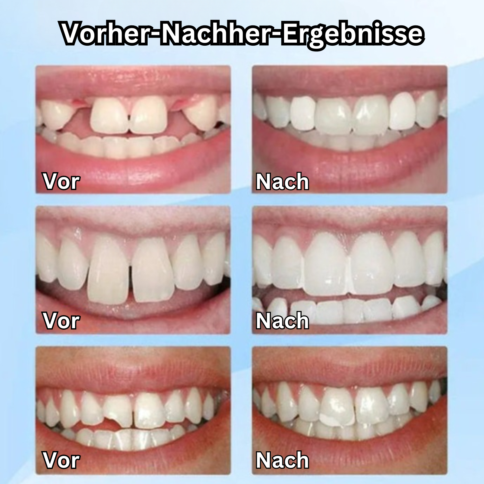 ToothCharm™️ - Formbare falsche Zähne (1+1 GRATIS)