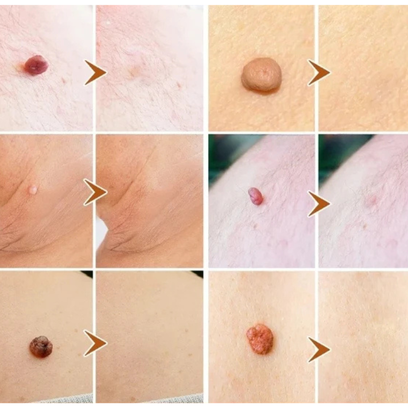 ClearSkin™ - Pflaster für Hautanhängsel
