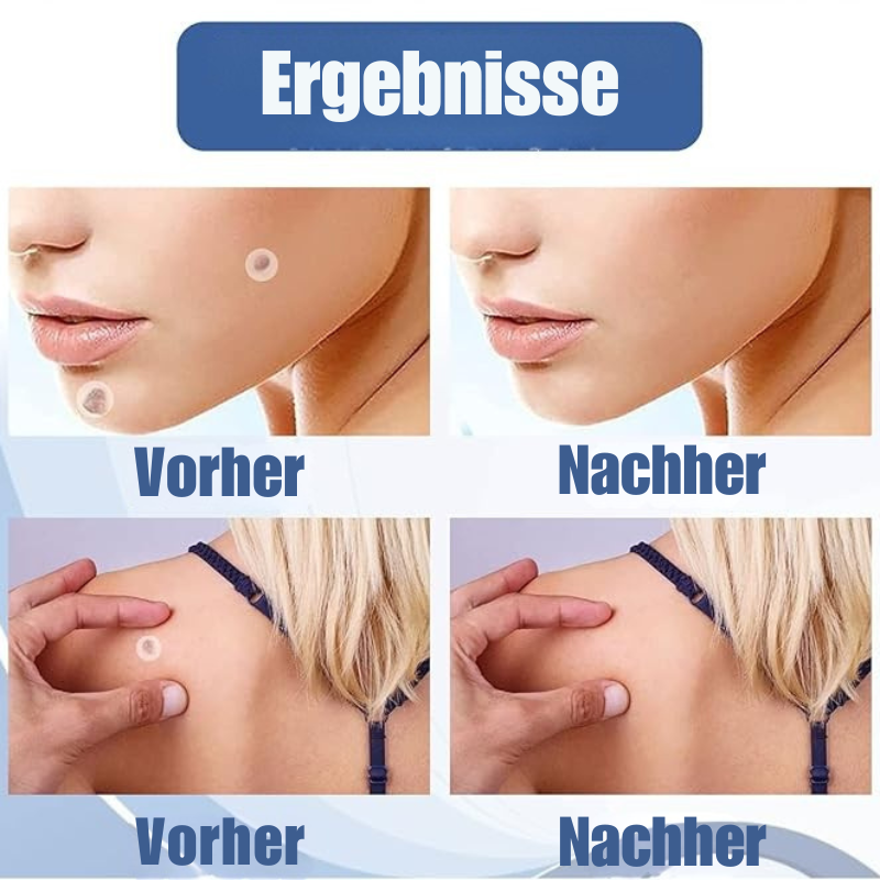 ClearSkin™ - Pflaster für Hautanhängsel