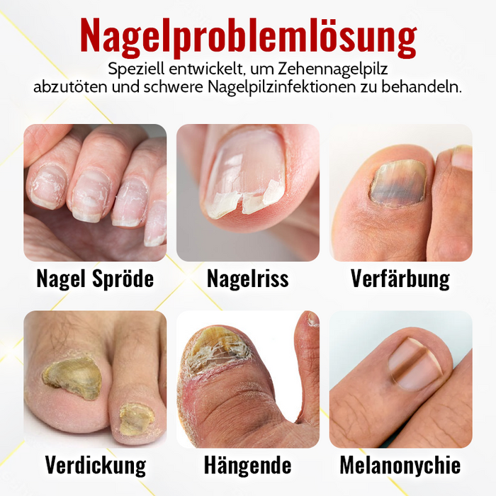 FungiFix™️ - Onychomykose Rapid Relief Öl (1+1 GRATIS)