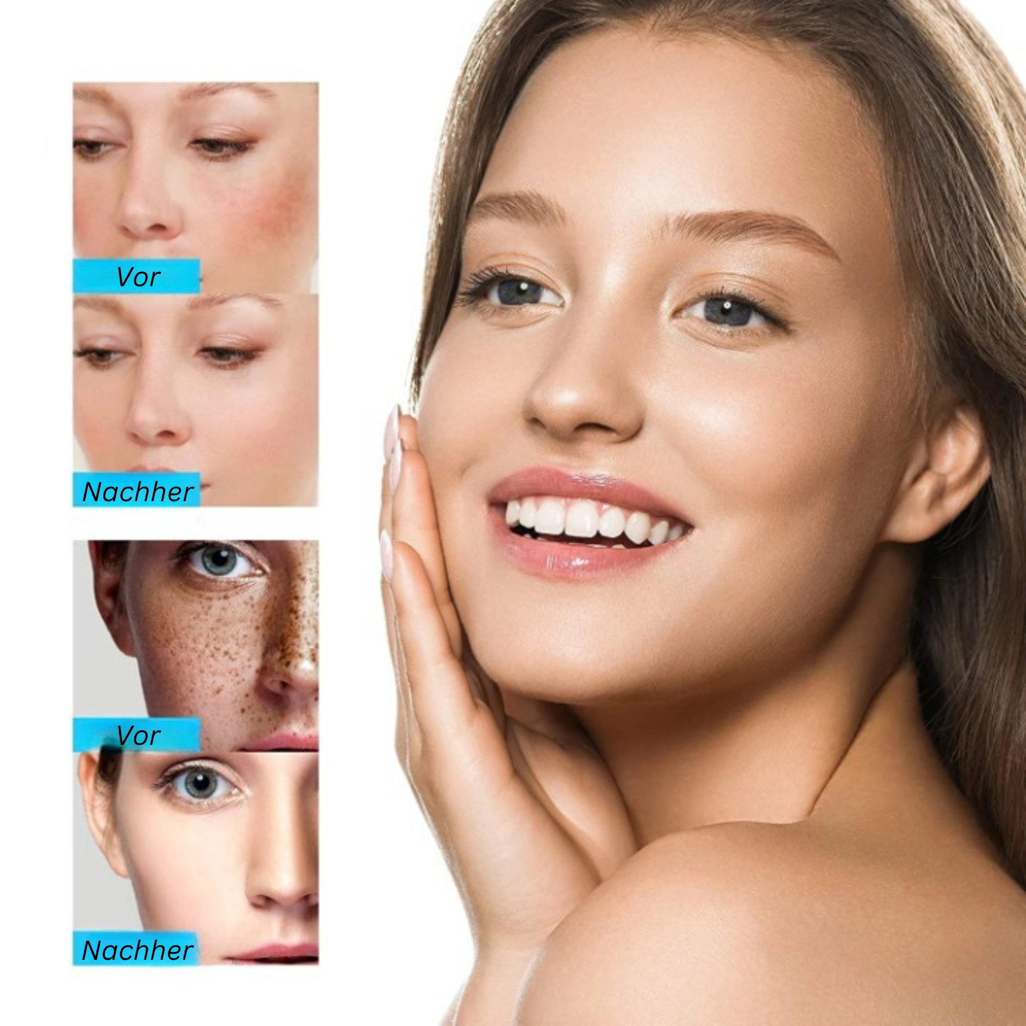 iBeaLee® Creme zur Aufhellung von Sommersprossen