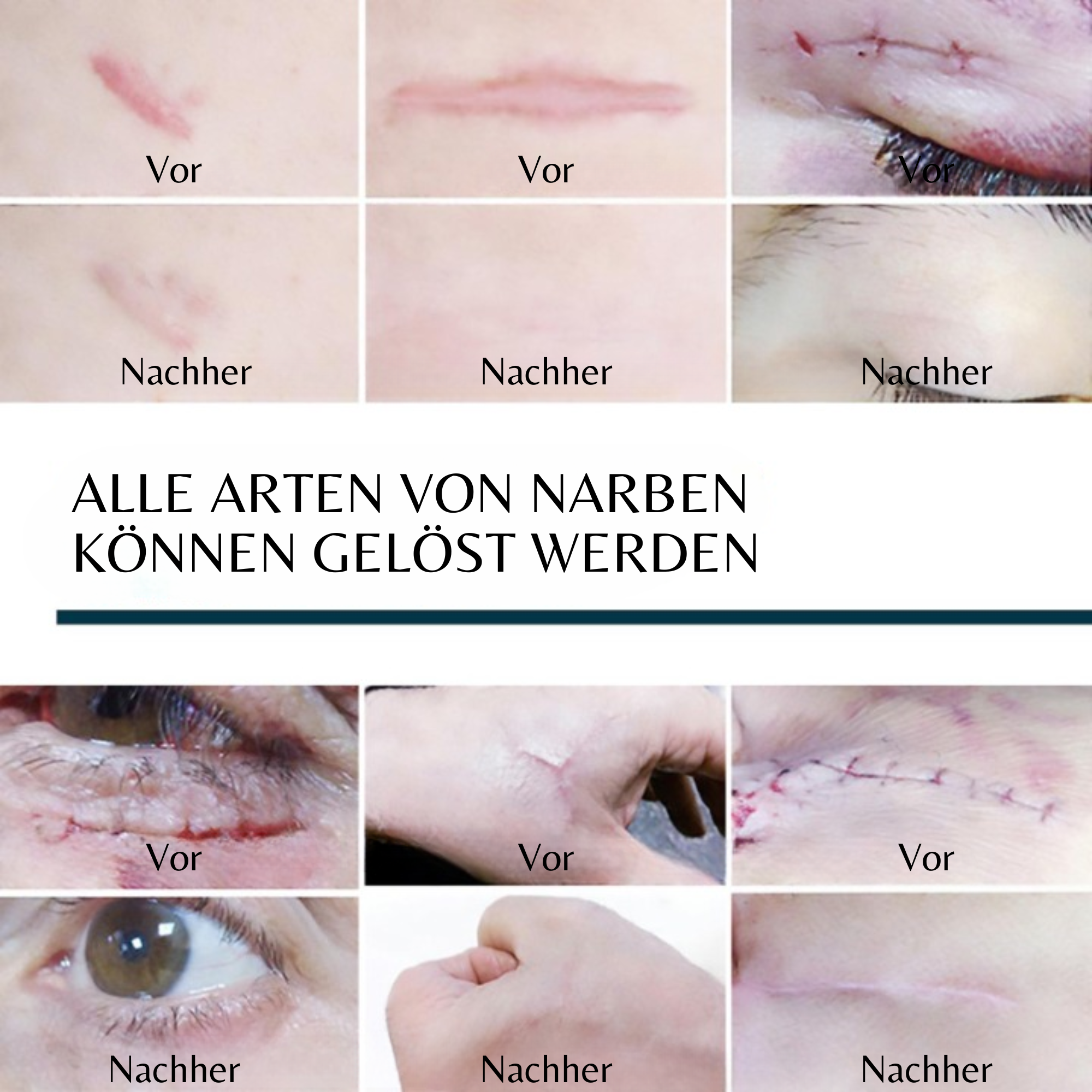 Eelhoe™️ I Advance-Narbengel