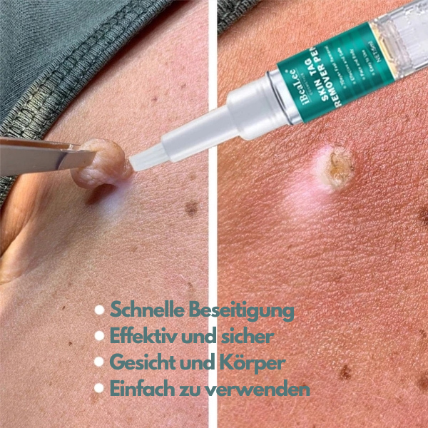 iBeaLee® - Hauttag Entferner